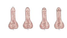Phimosis Stretcher Kit for curing tight foreskin - Phimostretch