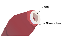 Phimosis Stretcher Kit for curing tight foreskin - Phimostretch