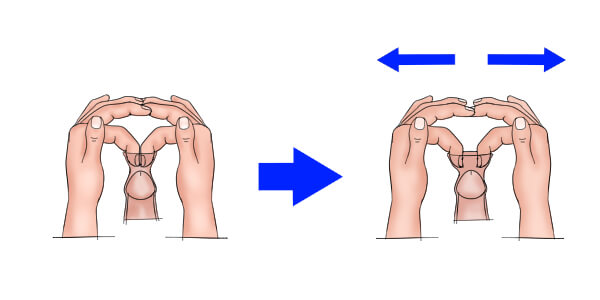 Phimosis Stretching: Helpful Illustrated Guide with Examples- by