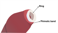Silicone tunnels for Phimosis