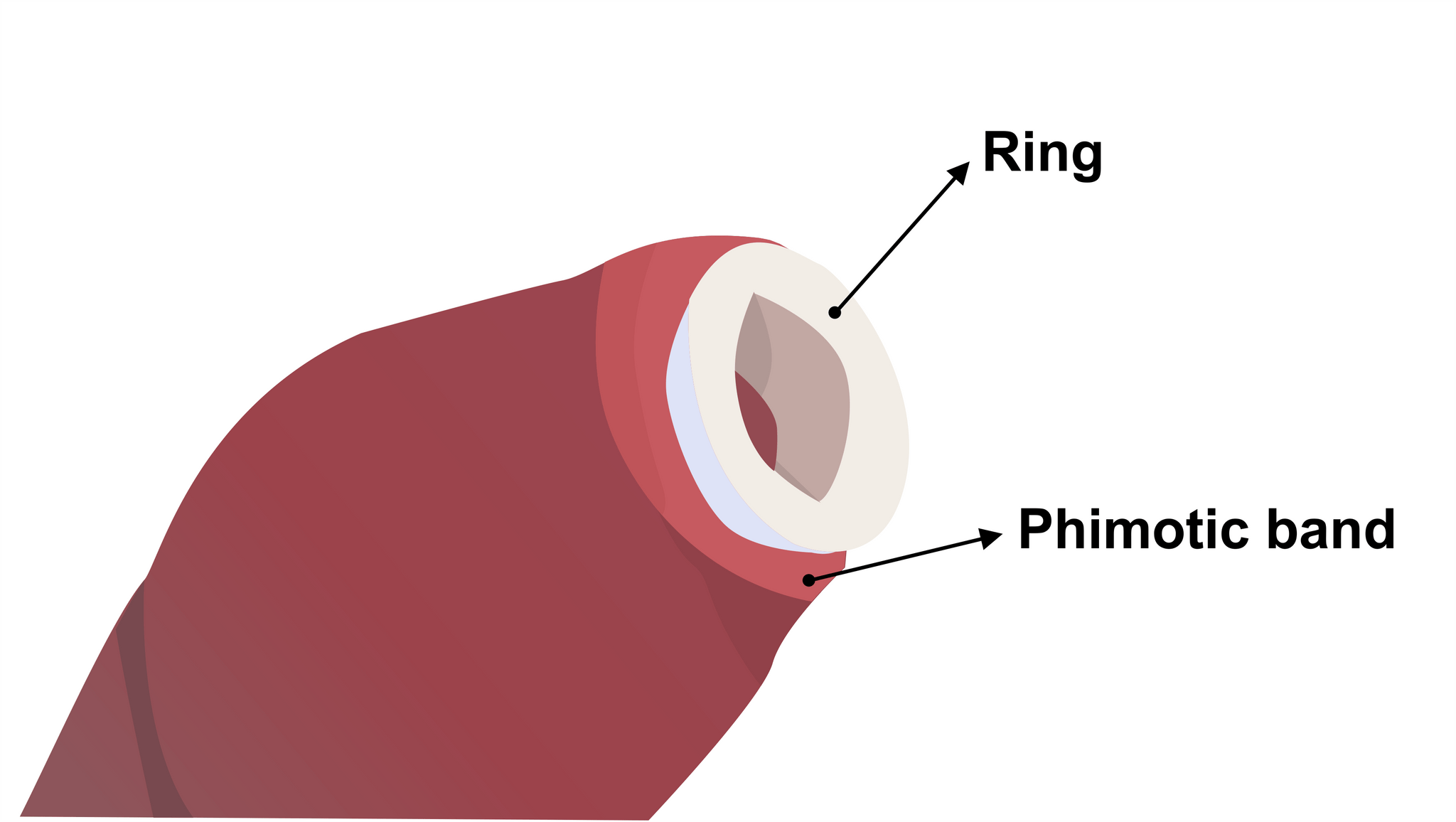 Phimostretch Phimosis Stretcher Rings Kit; 20 Rings (3 mm to 38 mm)